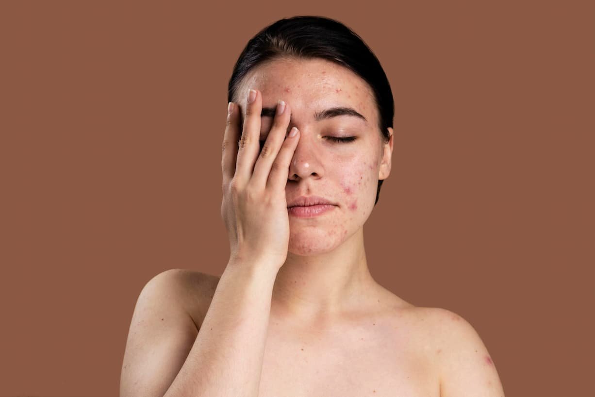 acne hormonal adulto