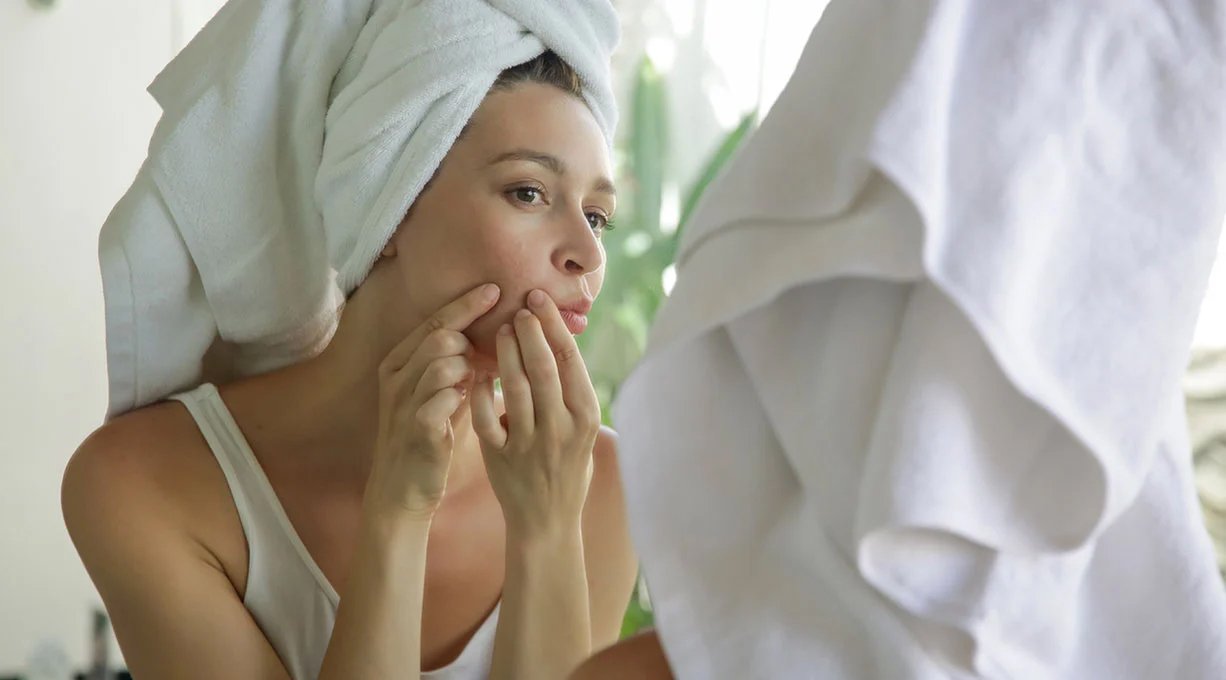 Signos del acne tardio