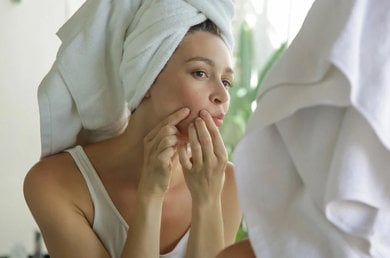 Signos del acne tardio