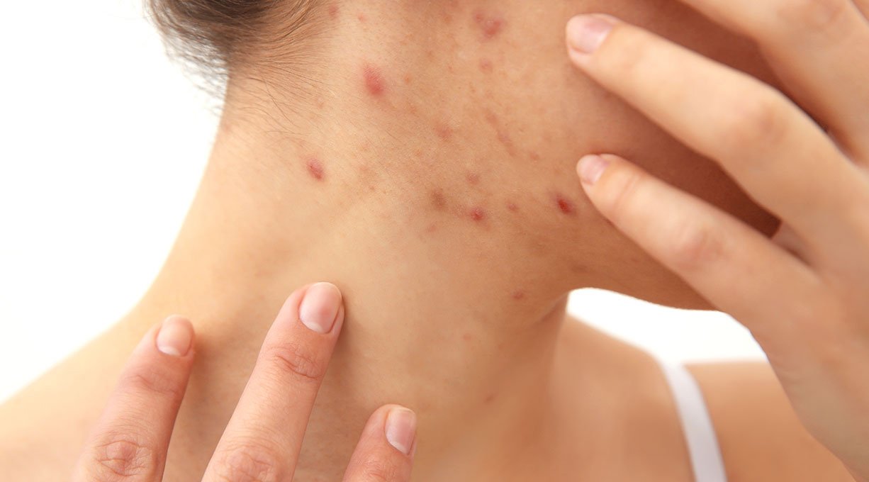 Causas del acne tardio