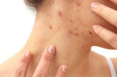 Causas del acne tardio