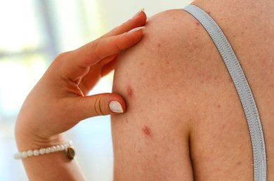 Cómo eliminar los granos de la espalda