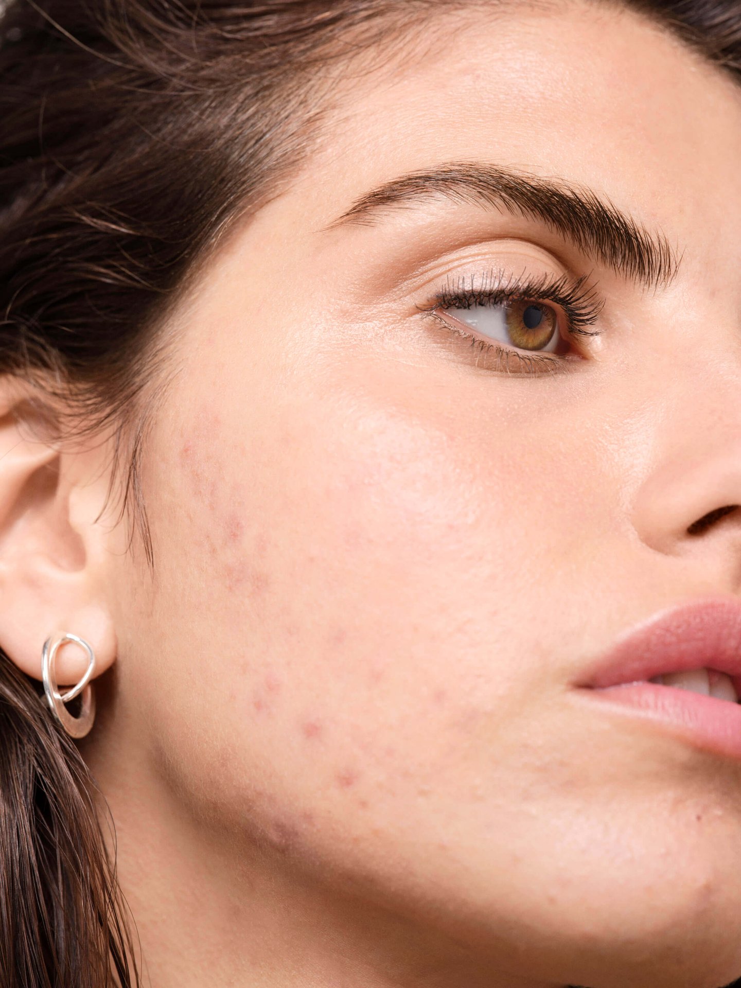 existe-una-relacion-entre-los-productos-lacteos-y-el-acne