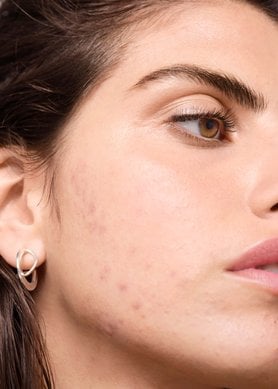 existe-una-relacion-entre-los-productos-lacteos-y-el-acne