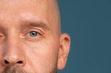 patas de gallo en hombres