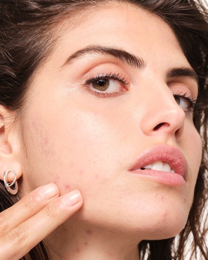 pueden-los-alimentos-causar-acne