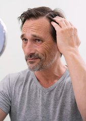caída de pelo hombre