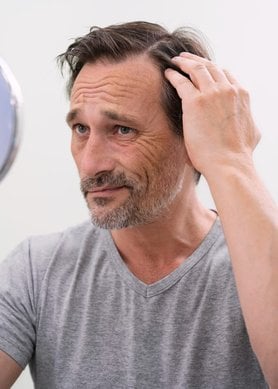 caída de pelo hombre