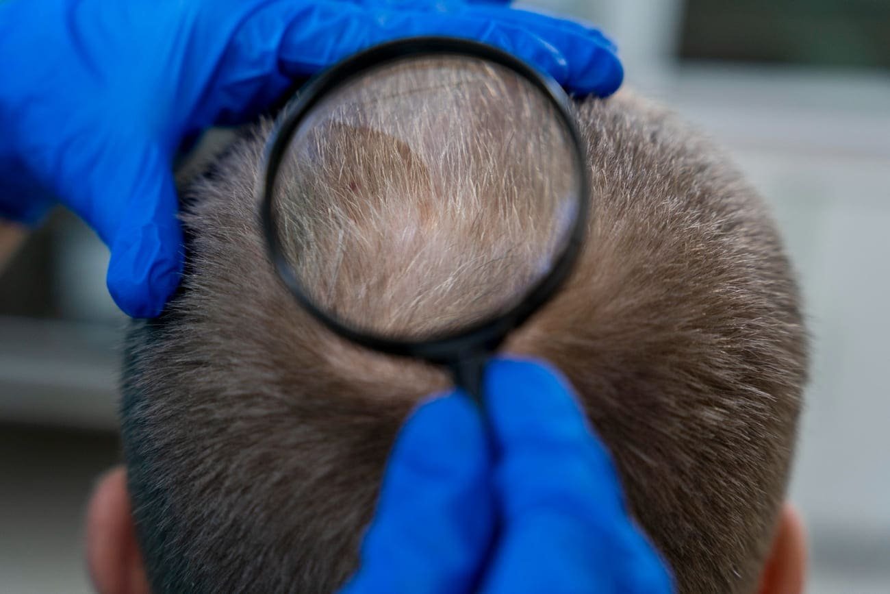 alopecia difusa hombre