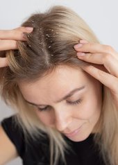 brote de dermatitis seborreica