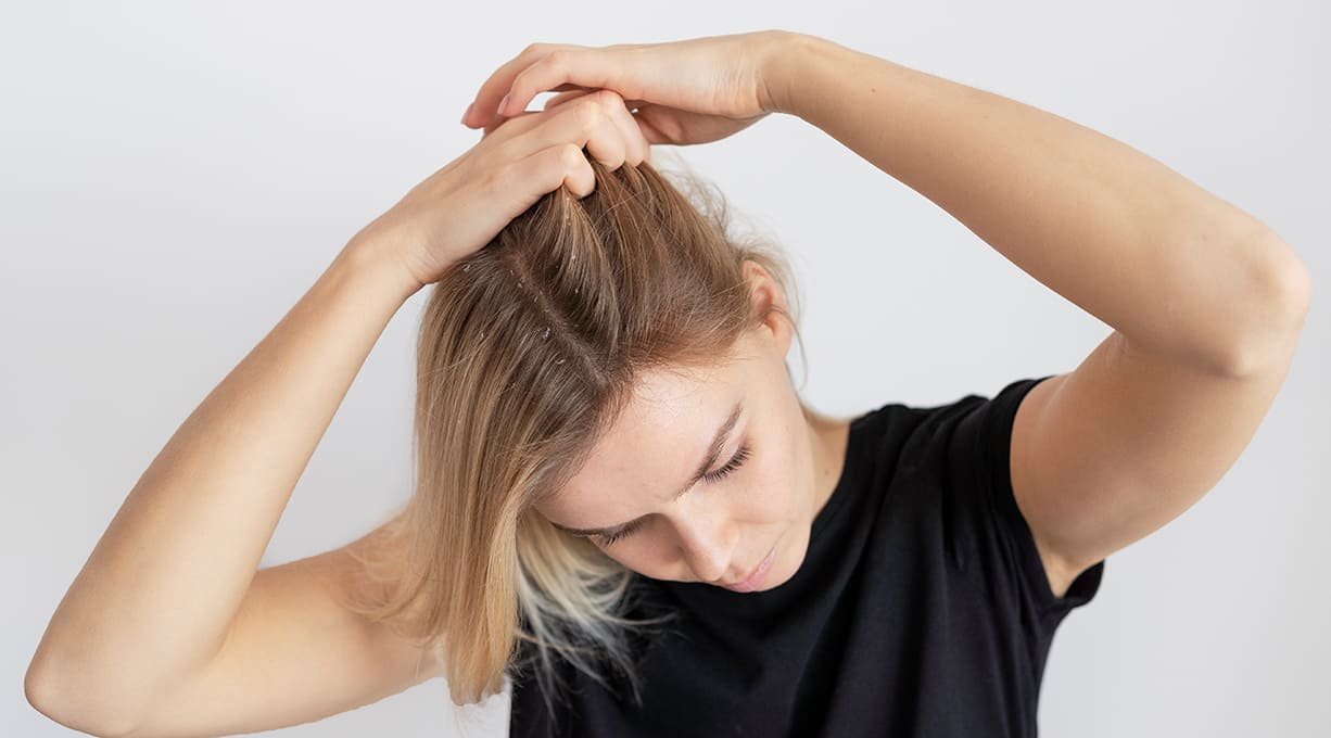 CÓMO TRATAR LA CASPA Y LA DERMATITIS SEBORREICA DEL CUERO CABELLUDO