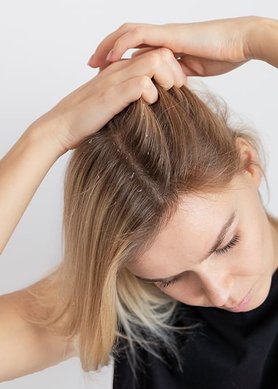 CÓMO TRATAR LA CASPA Y LA DERMATITIS SEBORREICA DEL CUERO CABELLUDO