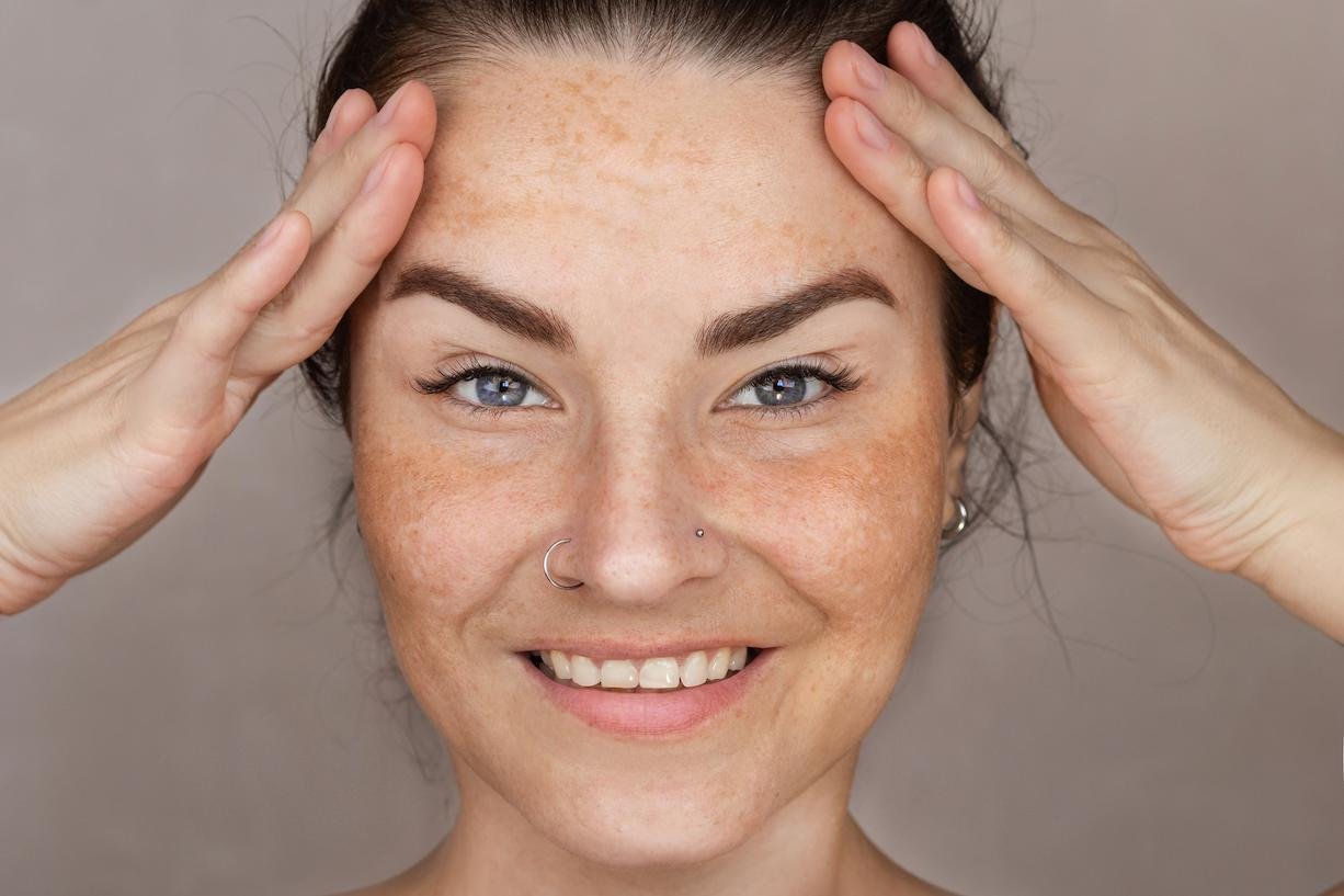 manchas pigmentarias cara