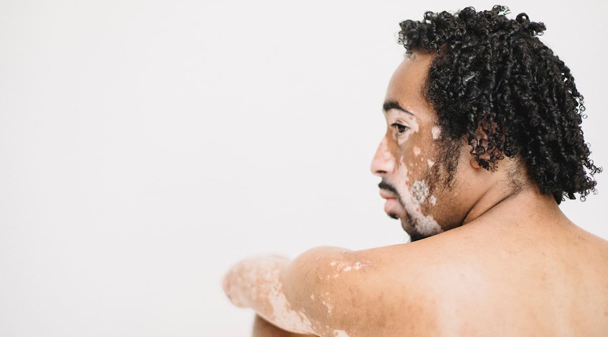 Vitíligo en la cara