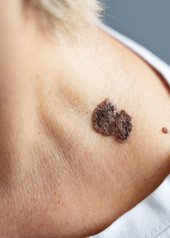 Queratosis seborreica