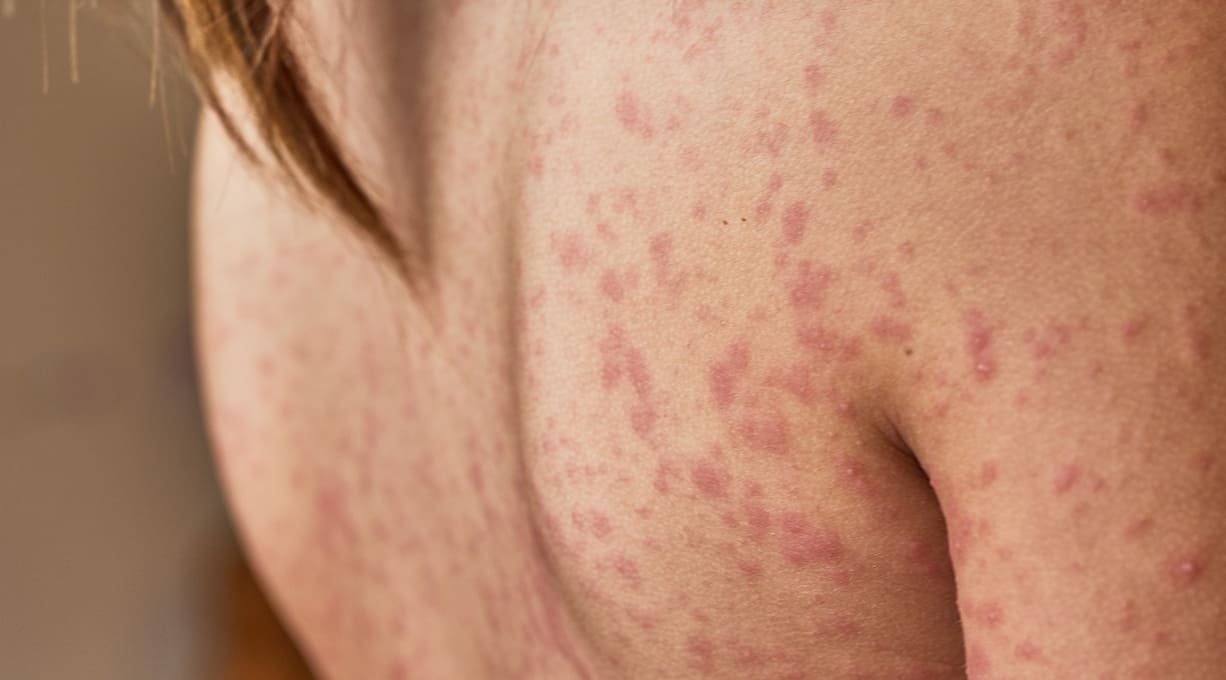 Sarpullido por calor