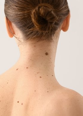 tipos de lunares