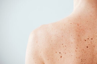 lunares rojos en la piel